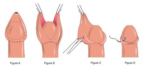 circumsion