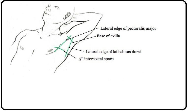 chest tube placement
