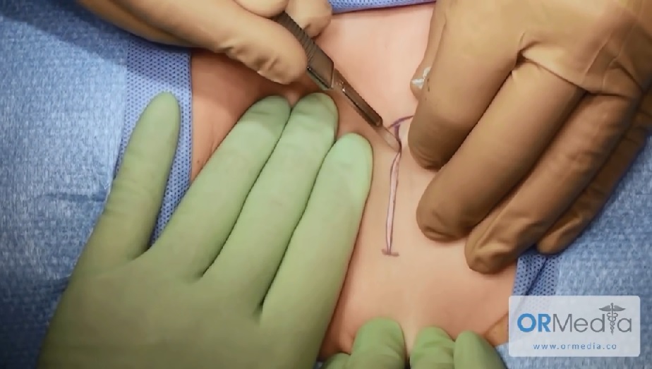 open Excision of Urachal Cyst