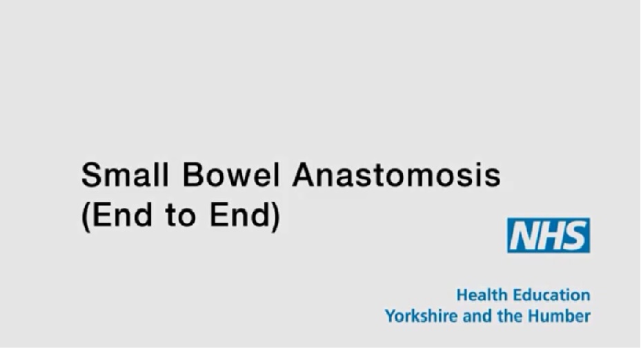 end to end small bowel anastomosis