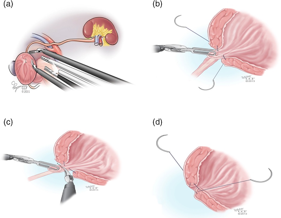 laparoscopic nephroureterectomy