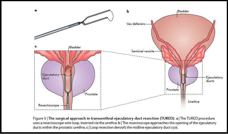  Transurethral Resection of Ejaculatory Ducts a Step by Step Guide