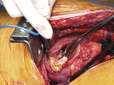 Anatrophic Nephrolithotomy