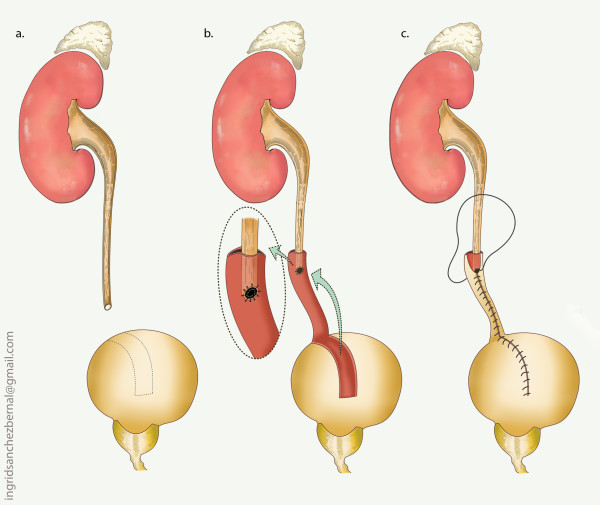 Boari Flap reconstruction