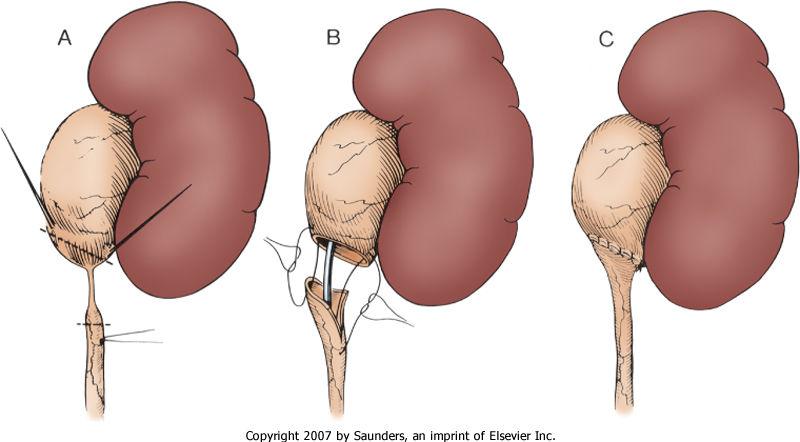 (Dismembered Pyeloplasty (Anderson-Hynes