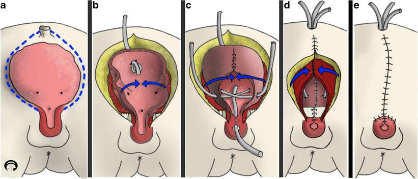 Bladder exstrophy repair