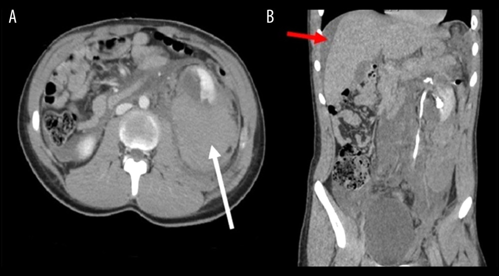 Nephrectomy in the Blunt Truma Case