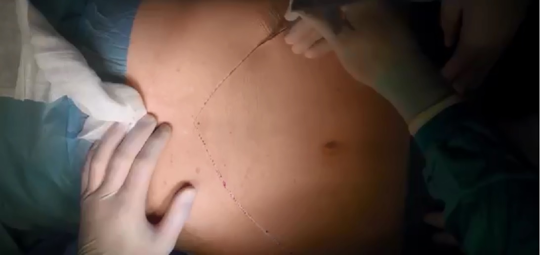 Laparoscopic Inguinal Hernia Repair « Dr. Dana L. Reiss