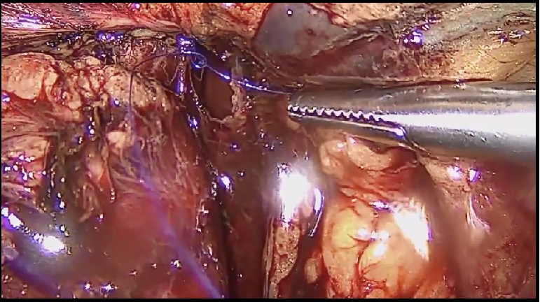 REPAIR OF I LIAC ARTERY IN THE RPLND