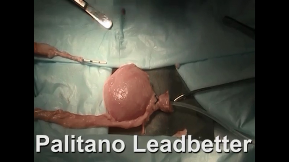 anti reflux surgery(Politano-Leadbetter Technique )                                 