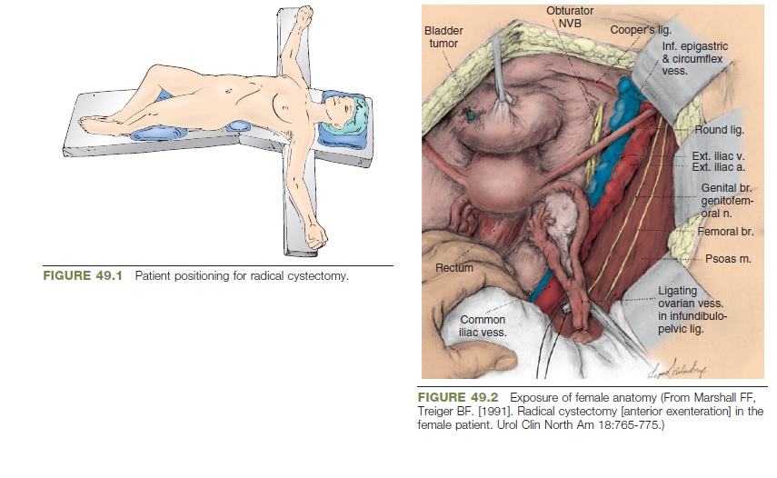 855px x 526px - Academic Learning Of Urology Procedures - female radical cystectomy