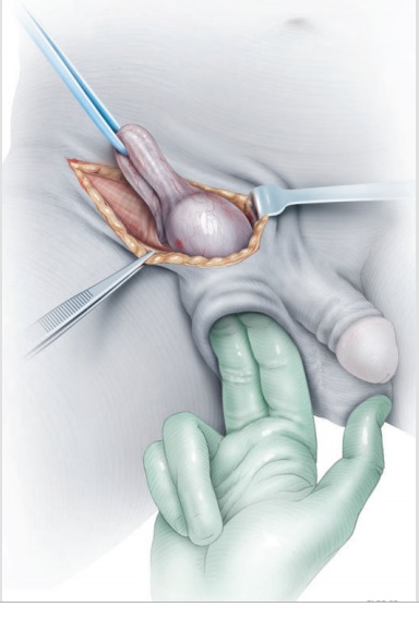 Radical orchiectomy