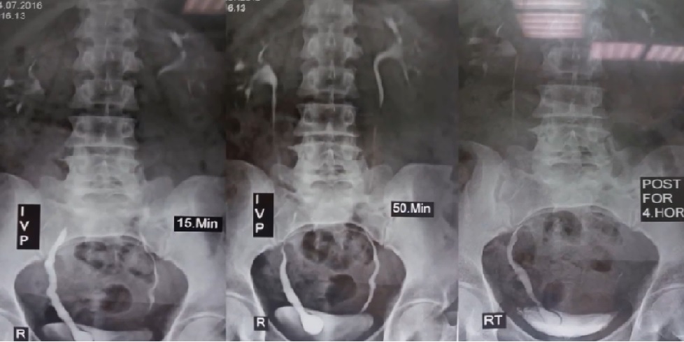 Ureterocele Endoscopic Incision and then ureteroscopy after than