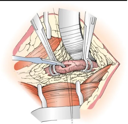open ureterolithotomy Gibson incision