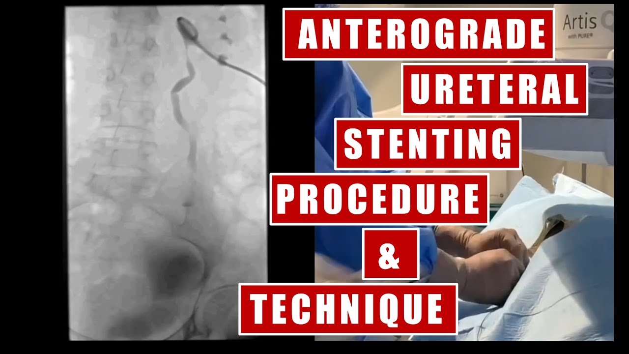 Trans-nephrostomy Ureteral Stent placement under fluoroscopy guidance: procedure and technique