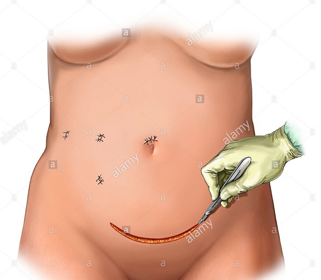 Pfannenstiel Incision