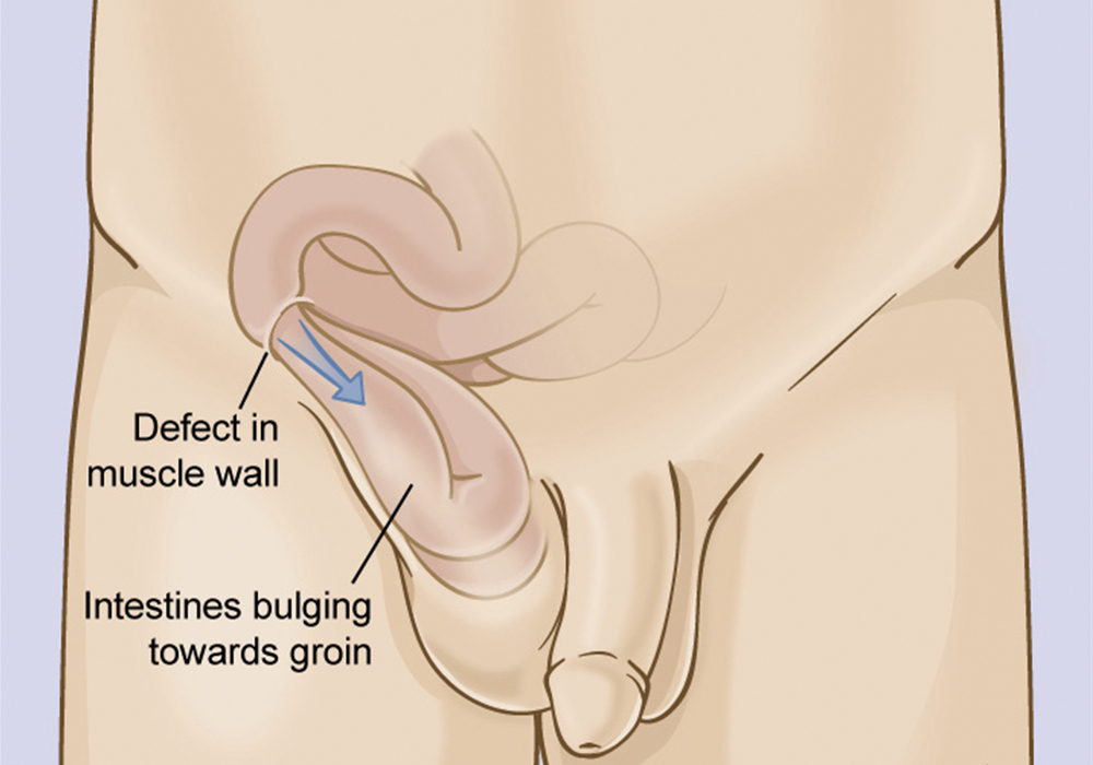 herniorrhaphy