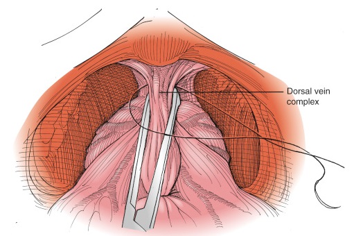 Dorsal Venous Complex Ligation