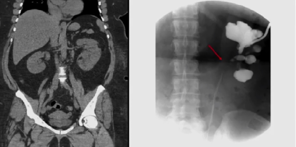 Robotic Ureterocalicostomy