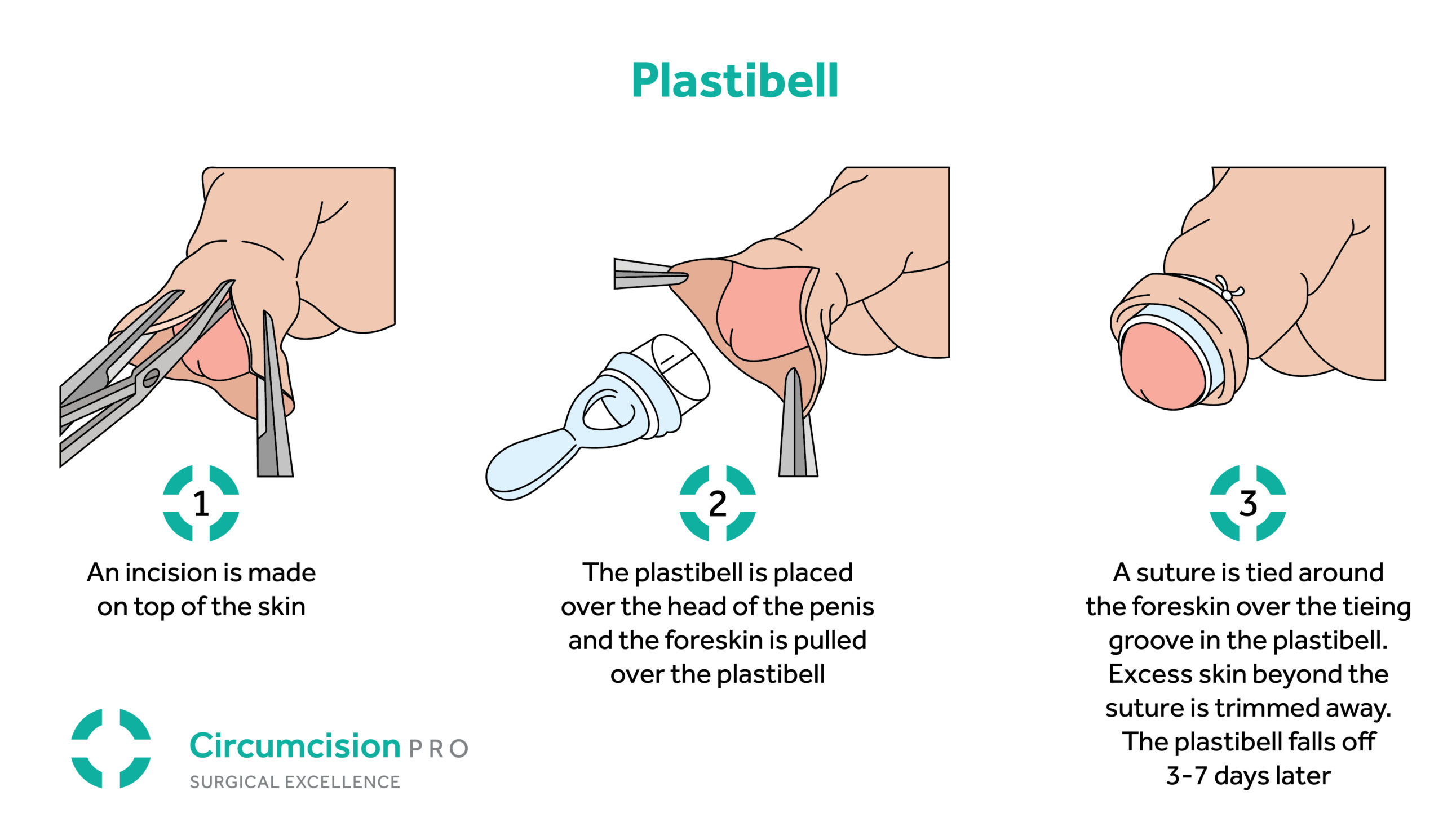 plastibell circumcision