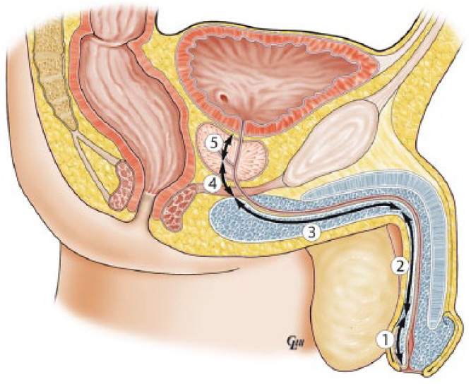  How to dilate the urethra and insert the resectoscope sheath