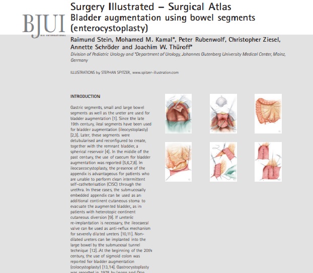 Surgery Illustrated –Surgical Atlas Bladder augmentation using bowel segments (enterocystoplasty) 