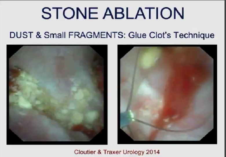 ureteroscopy/Glue clots Technique/reomve of dust and fragments