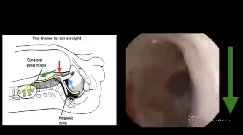 Our path to the kidney during ureteroscopy