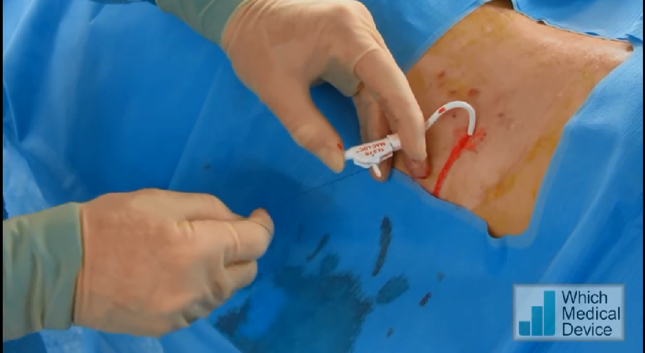 how to done nephrostomy procedure