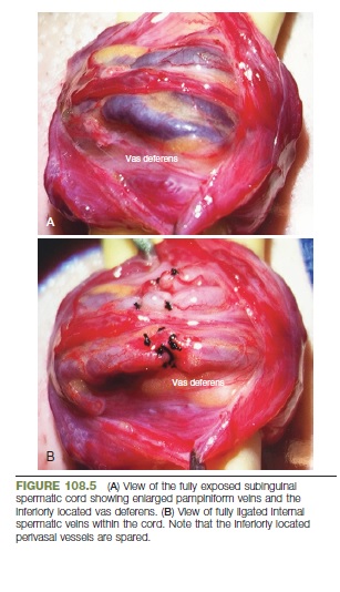 Varicocelectomy /sub inguinal/without microscope