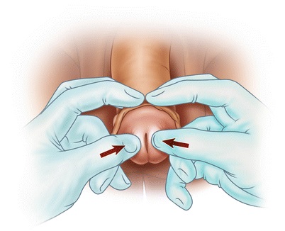 Paraphimosis reduction