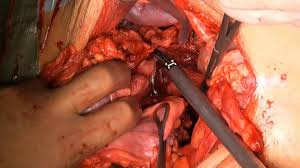 female radical cystectomy