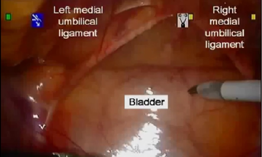 Robotic-partial cystectomy