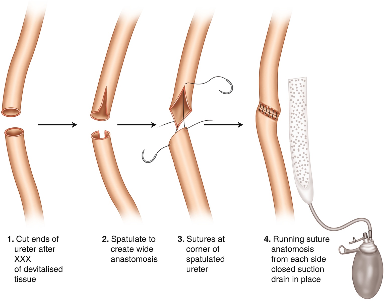 suture of the ureter
