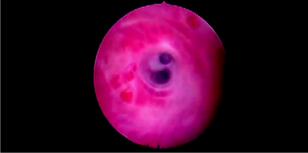 internal urethrotomy
