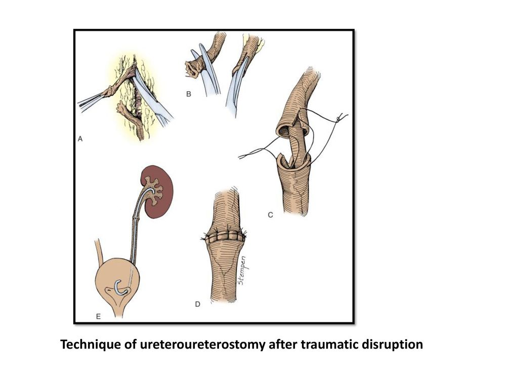 Ureteroureterostomy