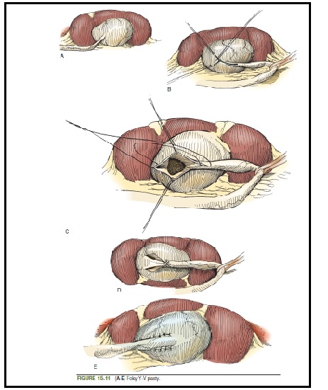 Laparoscopic Y-V pyeloplasty