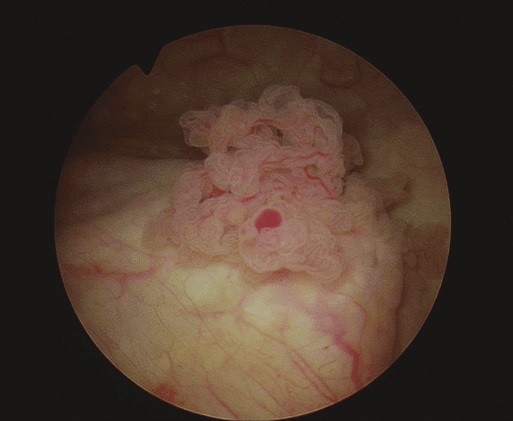 dealing with tumor in the ureter orifice