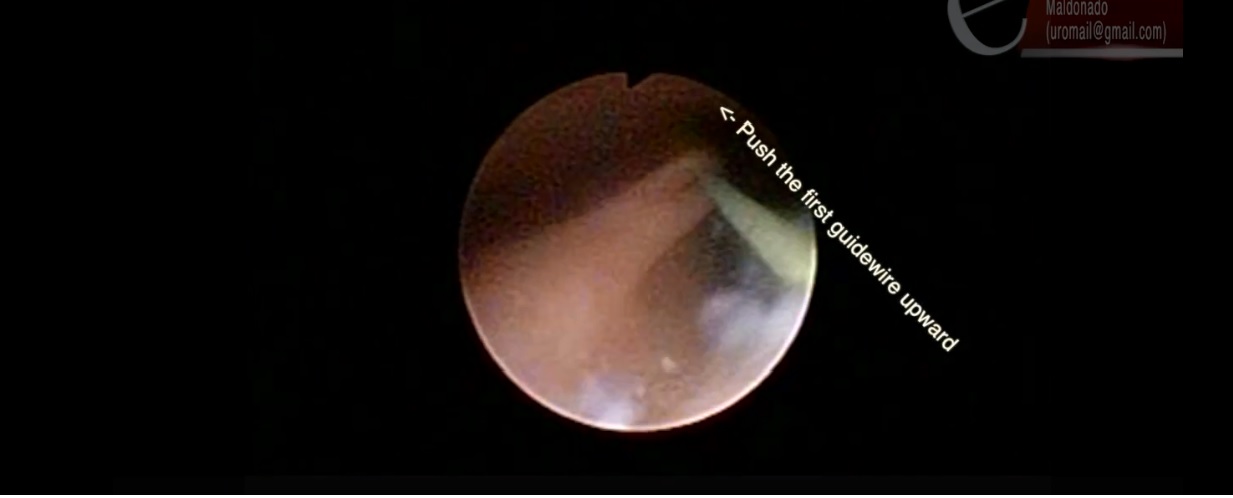 Tips & Tricks in Ureteroscopy - An Easy way to place a second guidewire