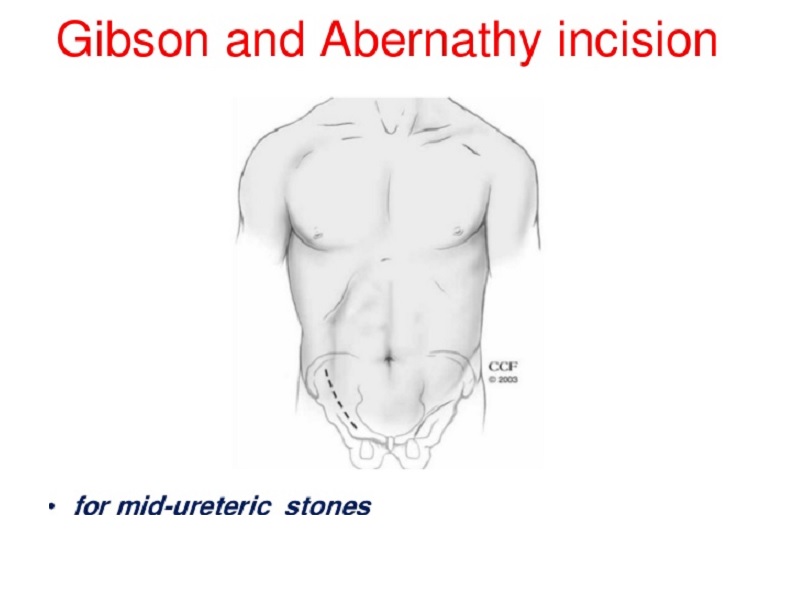             ureterolithotomy