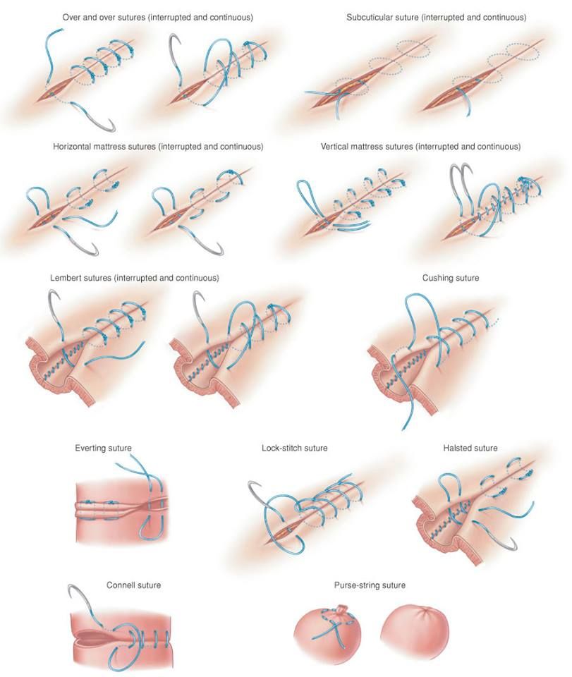 surgical sutures type